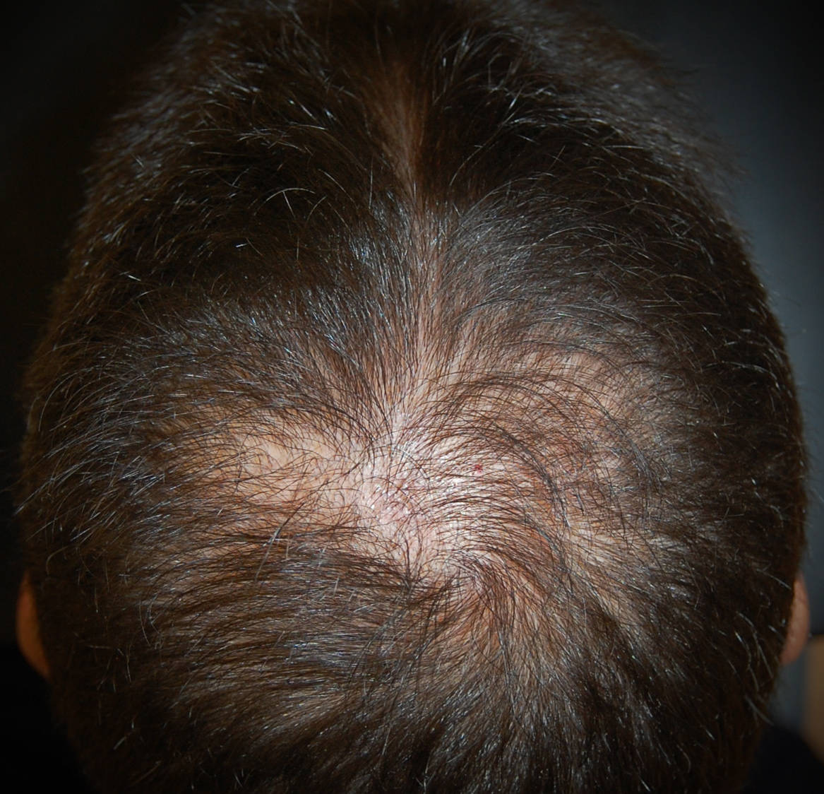 Alopecia androgenetica vertice chierica calvizie assottigliamento provoca Alopecia androgenetica o calvizie comune